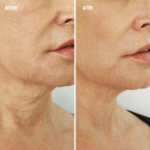 Radio-Frequency Skin-Tightening Package