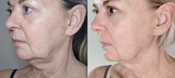 Age-Redefining Facial