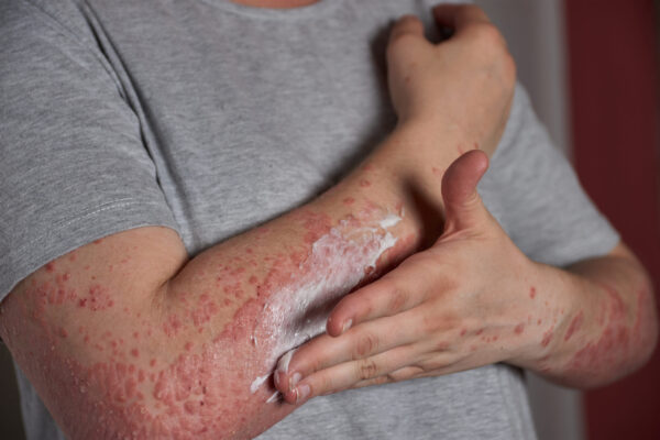 Eczema Package - Image 2