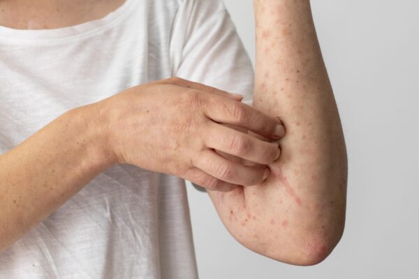 Eczema Package - Image 3